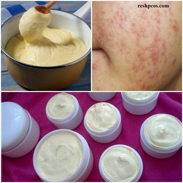 Mach ban cach nhan biet kem tron co chua corticoid nguy hai da