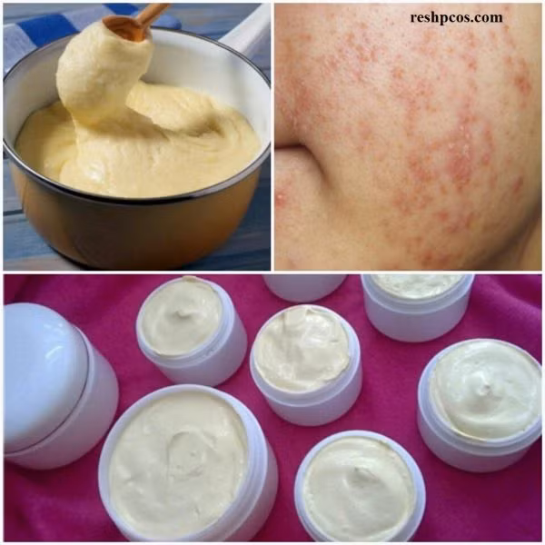 Mach ban cach nhan biet kem tron co chua corticoid nguy hai da