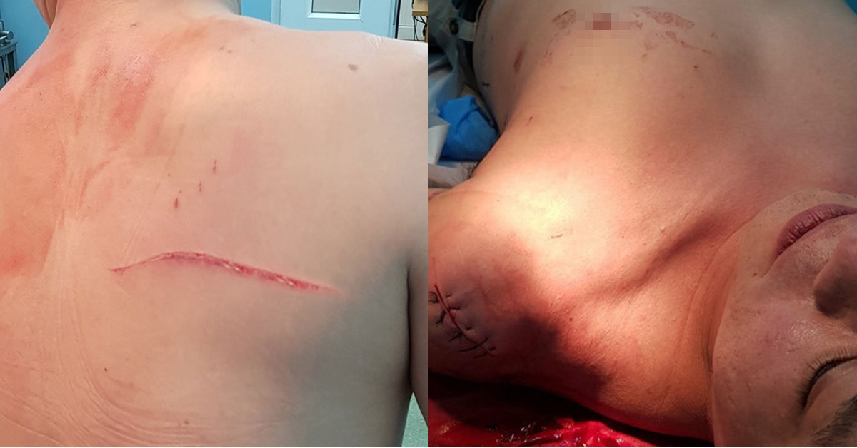 Giận chồng, bà Ngọc thuê giang hồ đánh ông Thái. (Bác sĩ Thái nhập viện do bị giang hồ chém tại phố đi bộ Nguyễn Huệ)