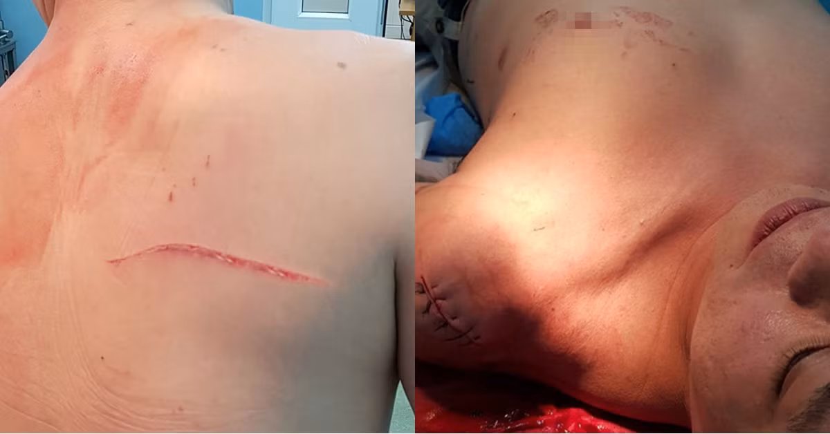 Giận chồng, bà Ngọc thuê giang hồ đánh ông Thái. (Bác sĩ Thái nhập viện do bị giang hồ chém tại phố đi bộ Nguyễn Huệ)