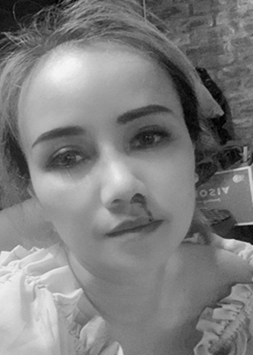 Cách đây không lâu, Hoàng Yến bị chồng cũ đấm gãy mũi. Ảnh: Vietnamnet