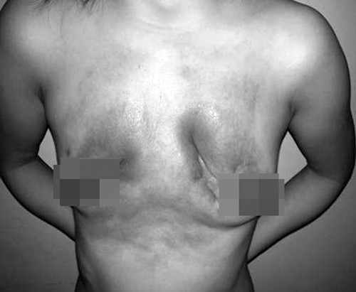 suyt chet vi bom silicon nang nguc hinh anh