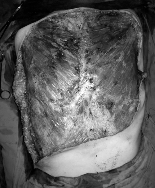 Một ca tai biến phải nạo bỏ hoàn toàn da cơ phần ngực do bơm silicon.