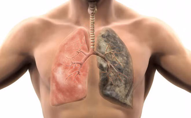 Nhung trieu chung canh bao benh nghiem trong ve phoi