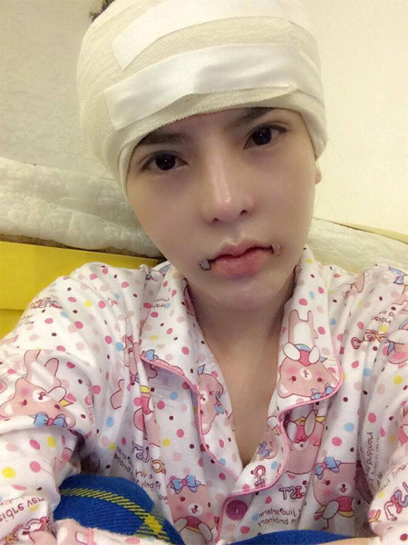 "Mình phẫu thuật nâng mũi, gọt cằm, chỉnh xương hàm cho hết hô, hút mỡ toàn thân, đặt túi ngực. Nói chung mình đã thực hiện gần như đầy đủ các loại hình phẫu thuật thẩm mỹ có hiện nay", cô nói.