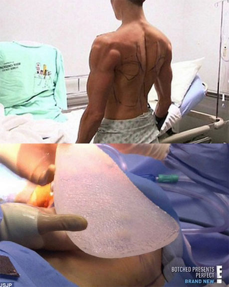 Mới đây, vào tháng 5, Justin Jedlica tiếp tục thực hiện một ca dao kéo kỳ quặc khác - lắp cánh vào sau lưng. Bộ cánh được làm từ silicon, do chính tay anh ta thiết kế. "Justin đã thực hiện hàng trăm ca phẫu thuật thẩm mỹ. Anh tìm đến tôi bởi chỉ có tôi mới dám làm những điều này" - Leif Roger, bác sĩ thẩm mỹ riêng của Ken phiên bản đời thực chia sẻ. Ảnh: Daily Mail.