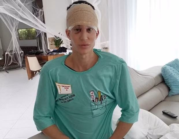 Theo đánh giá của các chuyên gia, đây là ca dao kéo nguy hiểm nhất đời chàng "búp bê sống". Bởi nếu không thuận lợi, anh có thể sẽ mất mạng hoặc bị mù vĩnh viễn. Mặc dù vậy, Justin vẫn quyết tâm lên bàn mổ thêm một lần nữa. Anh còn thực hiện cấy ghép cơ bắp sau lưng. Hai ca phẫu thuật này tiêu tốn của anh 40.000 USD. Ảnh: Daily Mail.