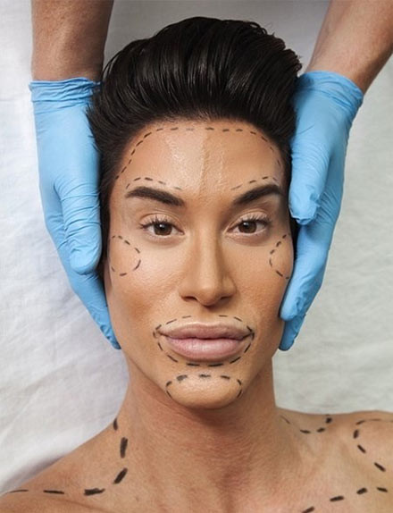 Theo Daily Mail, tháng 1 vừa qua, Justin Jedlica, một trong các búp bê sống hay Ken phiên bản đời thực (bạn trai Barbie) nổi tiếng nhất, gây chú ý với quyết định phẫu thuật gỡ bỏ đường tĩnh mạch trên trán. Justin cho biết, anh cảm thấy không hài lòng khi một số dây tĩnh mạch thường nổi lên mỗi lúc anh nói, cười... Ảnh: Daily Mail.