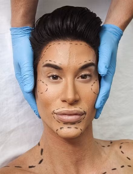 Theo Daily Mail, tháng 1 vừa qua, Justin Jedlica, một trong các búp bê sống hay Ken phiên bản đời thực (bạn trai Barbie) nổi tiếng nhất, gây chú ý với quyết định phẫu thuật gỡ bỏ đường tĩnh mạch trên trán. Justin cho biết, anh cảm thấy không hài lòng khi một số dây tĩnh mạch thường nổi lên mỗi lúc anh nói, cười... Ảnh: Daily Mail.