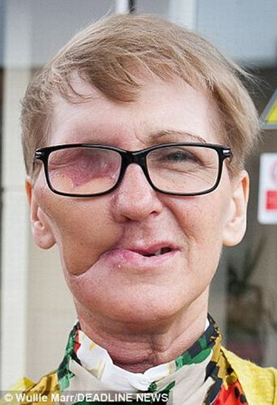 Tiếp theo, Helen được phẫu thuật loại bỏ khối u, tái tạo gương mặt. Bà trở về nhà và tiếp tục chữa ung thư bằng xạ trị sau 10 ngày nằm viện.