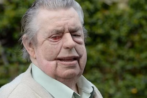 Người đàn ông này đã được tái tạo gương mặt sau khi điều trị ung thư mặt. Gương mặt ông tạm ổn.