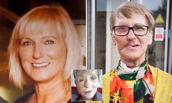 Mới đây, bà Helen Butchart, 54 tuổi, người Anh, đã công bố hình ảnh gương mặt mình bị bệnh ung thư mặt hủy hoại.