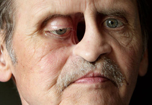 Một dạng tổn thương do ung thư mặt gây ra. Đây cũng là ca nhẹ, vì những trường hợp ung thư mặt nặng nhất gây tổn thương khủng khiếp đến nỗi sẽ quá đáng sợ để nhìn.