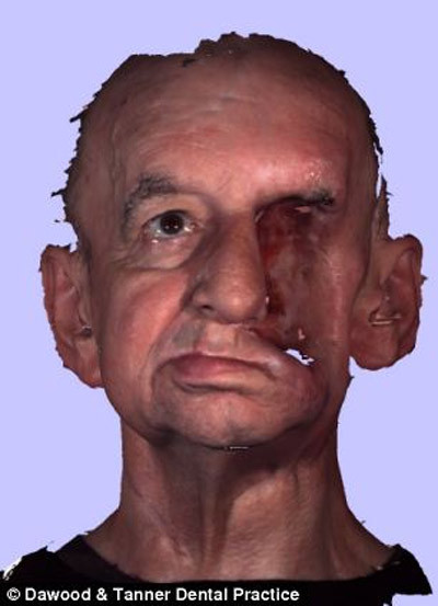 Bệnh hay gặp ở lứa tuổi ngoài 45, đàn ông hay mắc hơn phụ nữ và nguy cơ tăng ở những người hút thuốc, uống rượu.