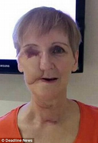 Cả mắt của Helen cũng bị hủy hoại, và các bác sĩ lại phải loại bỏ mắt cho bà.