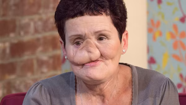 Tuy gương mặt biến dạng, nhưng người phụ nữ này đã giữ được mạng sống do điều trị thành công.