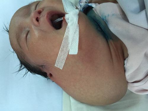 Thai nhi mác kẹt ỏ vùng kín của mẹ vì khói u khỏng lò