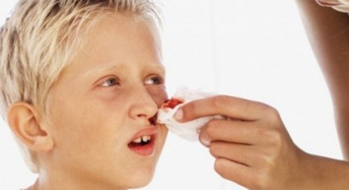 Dù rất hiếm song việc ngửa đầu khiến lượng lớn máu cam gây nghẹt thở hoàn toàn có thể xảy ra.