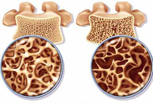 Nhung cũng mang lại tác dụng tăng tạo xương, giảm tình trạng và tốc độ loãng xương.