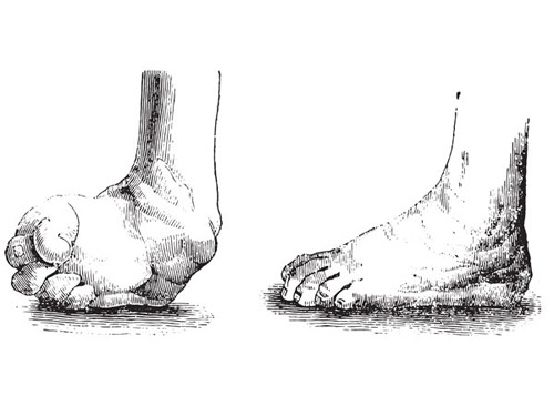 Ngón chân quặp. Ngón chân, tay quặp rất có thể là dấu hiệu nhận biết bệnh ung thư phổi. Đôi khi nó là kết quả của tình trạng viêm phổi, các vấn đề về tim mạch, bệnh đường ruột. Để đảm bảo sức khỏe, bạn nên khám bác sĩ để phát hiện đúng căn nguyên vấn đề.