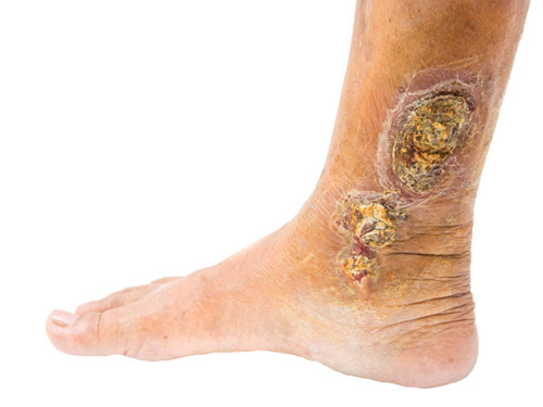 Vết loét khó lành. Nhiều người tin rằng vết loét khó lành trên chân tay bắt nguồn từ tình trạng “dữ da” mà không biết rằng nó là dấu hiệu cảnh báo mắc tiểu đường. Khi không kiểm soát được lượng đường trong máu, tình trạng lưu thông máu khó có thể diễn ra, đặc biệt là bàn chân. Việc khó lưu thông máu về lâu dài khiến các vết thương được cung cấp lượng máu hạn chế, trở nên lâu khỏi hơn.