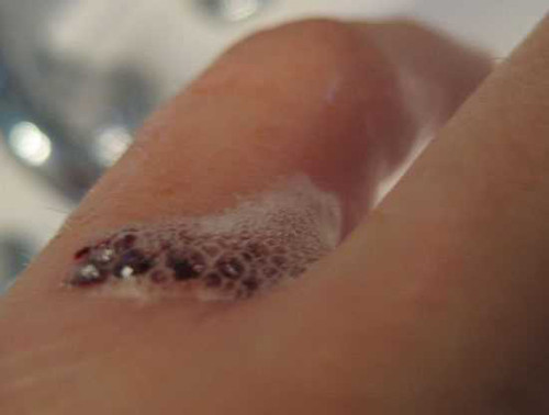 Nhận định trên được xác nhận bởi bác sĩ Aaron Clark làm việc tại Trung tâm Y tế Đại học Ohio (Mỹ). Hiện các bác sĩ khuyên không nên tự ý dùng oxy già rửa vết thương bởi nó ảnh hưởng tiêu cực đến các tế bào khỏe, làm chậm quá trình liền da ở vết thương.