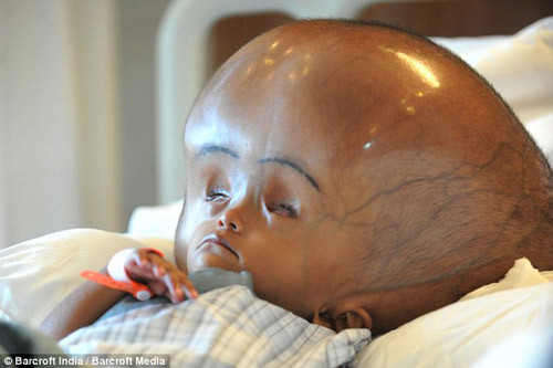 Mắc não úng thủy, người bệnh có biểu hiện mắt luôn nhìn xuống (mắt mặt trời lặn), tay, chân mềm nhũn, kém linh hoạt. (Ảnh bé gái Roona Begum 3 tuổi, người Ấn Độ mắc chứng não úng thủy khiến đầu em căng phồng, mắt luôn nhìn xuống).