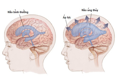 Vậy căn bệnh não úng thủy mà Quốc vương Thái Lan đang mắc là bệnh như thế nào? Não úng thủy xuất hiện do tình trạng dư thừa một loại chất lỏng trong não còn gọi là dịch não tủy (DNT). Sự dư thừa này dễ làm đầu bệnh nhân có dấu hiệu to dần, làm nhu mô não bị tổn thương.