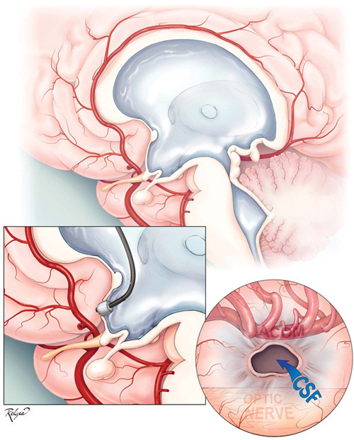 Não úng thủy gây tổn thương trực tiếp đến hệ thần kinh trung ương, thậm chí nó có thể để lại di chứng trầm trọng nếu không điều trị sớm và đúng cách.