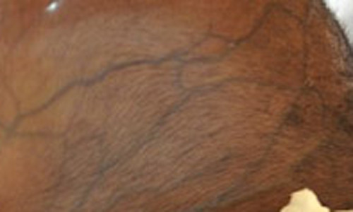 Ở người lớn, não úng thủy ít có khả năng gây tăng kích thước đầu song nó có thể khiến các mạch máu da đầu giãn to hơn bình thường.