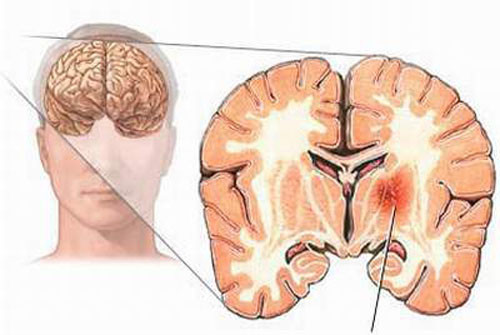 Bên cạnh đó, bệnh nhân có thể đối diện nguy cơ nhiễm trùng liên quan đến các vết mổ, xuất huyết não, thậm chí là động kinh.