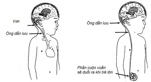 Đặt shunt não thất-ổ bụng (ventriculoperitoneal-VP) là phương pháp đặt shunt phổ biến nhất trong đó đầu ở xa của shunt được luồn vào trong khoang bụng. Ngoài ra, một số phương pháp đặt shunt khác cũng được áp dụng như đặt shunt não thất-tâm nhĩ (ventriculoatrial -VA) dẫn về tim; đặt shunt não thất-màng phổi (ventriculopleural) dẫn thoát vào niêm mạc phổi và đặt shunt thắt lưng-ổ bụng (lumboperitoneal) giúp dẫn dịch não tủy từ các ống tủy sống vào trong khoang bụng.