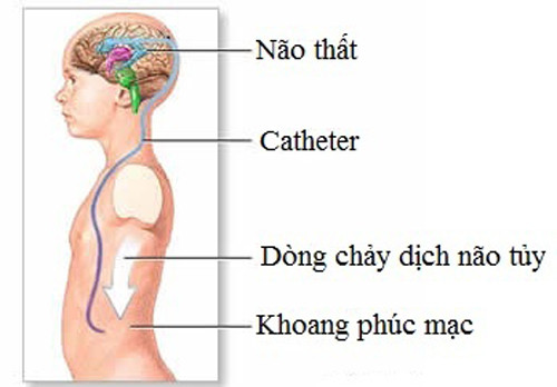 Phương pháp điều trị não úng thủy thường gặp nhất là giải phẫu đặt shunt. Ở đó, shunt là một ống dẻo đặt vào hệ thống não thất giúp chuyển hướng dòng chảy của dịch não tủy sang một vùng khác của cơ thể, nơi nó có thể được hấp thụ.