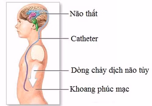 Phương pháp điều trị não úng thủy thường gặp nhất là giải phẫu đặt shunt. Ở đó, shunt là một ống dẻo đặt vào hệ thống não thất giúp chuyển hướng dòng chảy của dịch não tủy sang một vùng khác của cơ thể, nơi nó có thể được hấp thụ.