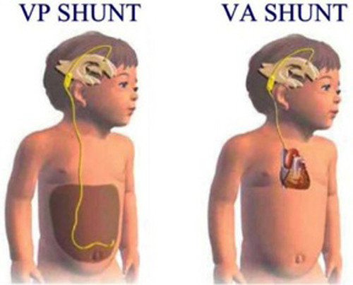 Dù mang lại hiệu quả rõ rệt nhất song giống như các phương pháp điều trị khác, đặt shunt có thể mang lại những rủi ro không mong đợi.