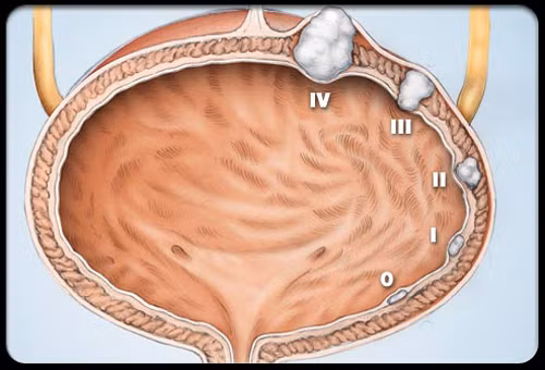 Nghiêm trọng nhất, tiểu tiện nhiều lần bắt nguồn từ ung thư bàng quang. Mắc bệnh này, ngoài việc đi tiểu nhiều, bệnh nhân còn xuất hiện cảm giác đau đớn, không kiểm soát được nhu cầu, gây tắc đường nước tiểu.