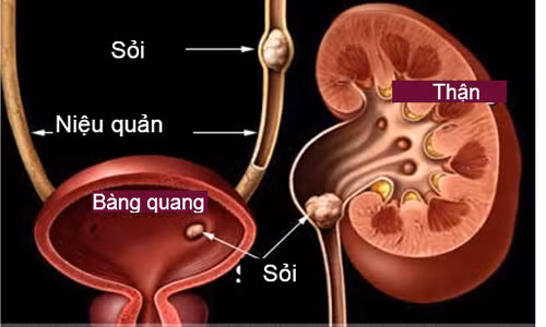 Một trong những lý do khiến tần suất đi tiểu của bạn tăng đột ngột là nhiễm khuẩn đường tiết niệu, phì tiền liệt tuyến. Tình trạng viêm nhiễm gây kích thích bàng quang và niệu đạo dẫn đến đi tiểu nhiều lần, tiểu không kiểm soát, tiểu ra máu. Lý giải điều này, các nhà khoa học tin rằng sự bất thường ở ống niệu đạo là nguyên nhân khiến bàng quang phải làm việc thường xuyên hơn nhằm đẩy nước thải ra ngoài.