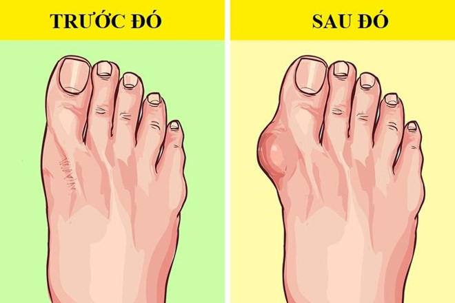 Nguy cơ viêm gân và vẹo ngón chân cái: Tư thế thay đổi xảy ra khi đi dép xỏ ngón sẽ gây áp lực lớn hơn lên khớp của chân. Các khớp này sau đó phải nỗ lực nhiều hơn để bù đắp sự mất cân bằng. Do đó, nó khiến bàn chân gặp phải một loạt vấn đề như đau, viêm gân và vẹo ngón chân cái nghiêm trọng.