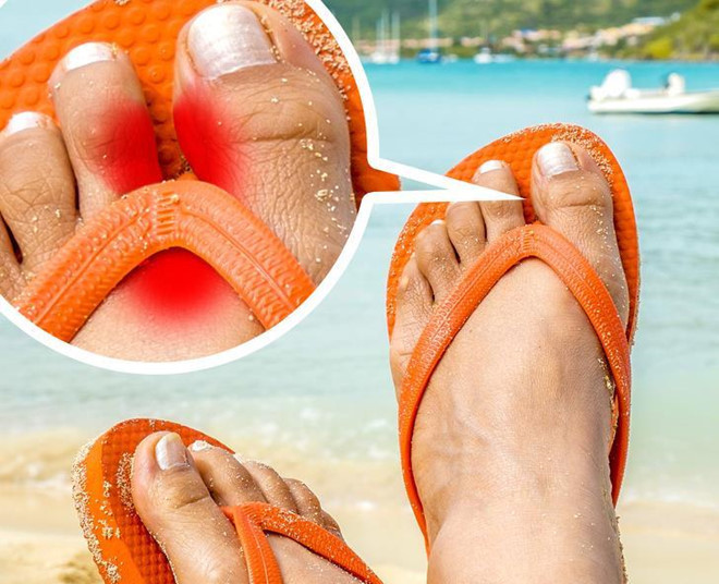 Phồng rộp chân: Phần đai của dép xỏ ngón thường xuyên cọ xát vào da khi bạn bước đi. Điều đó có nghĩa là chúng sẽ kích thích da, gây ra những vết phồng rộp đau đớn, thậm chí là vết thương hở, khiến bàn chân dễ bị nhiễm vi khuẩn.