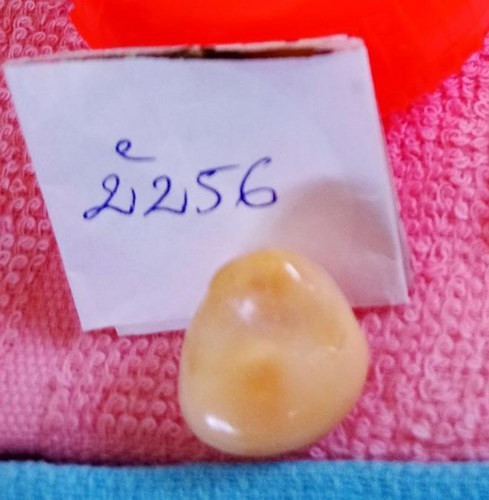 Tháng 6 vừa qua, 1 ngư dân ở tỉnh Bạc Liêu đã từng bắt được ốc hoàng đế có chứa viên ngọc lớn rất giá trị. (Ảnh: Báo Tiền phong)./.