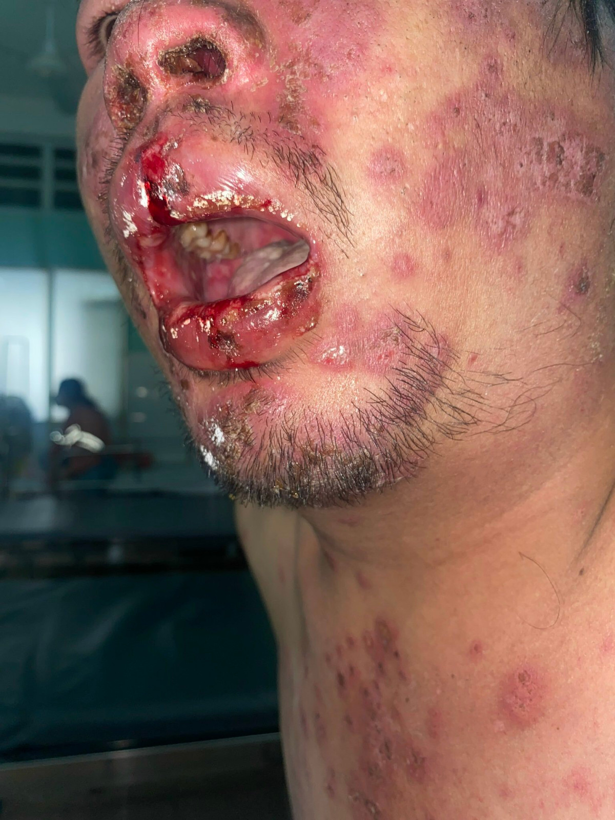 Lo loet toan than, rung toc vi benh Rowell hiem gap