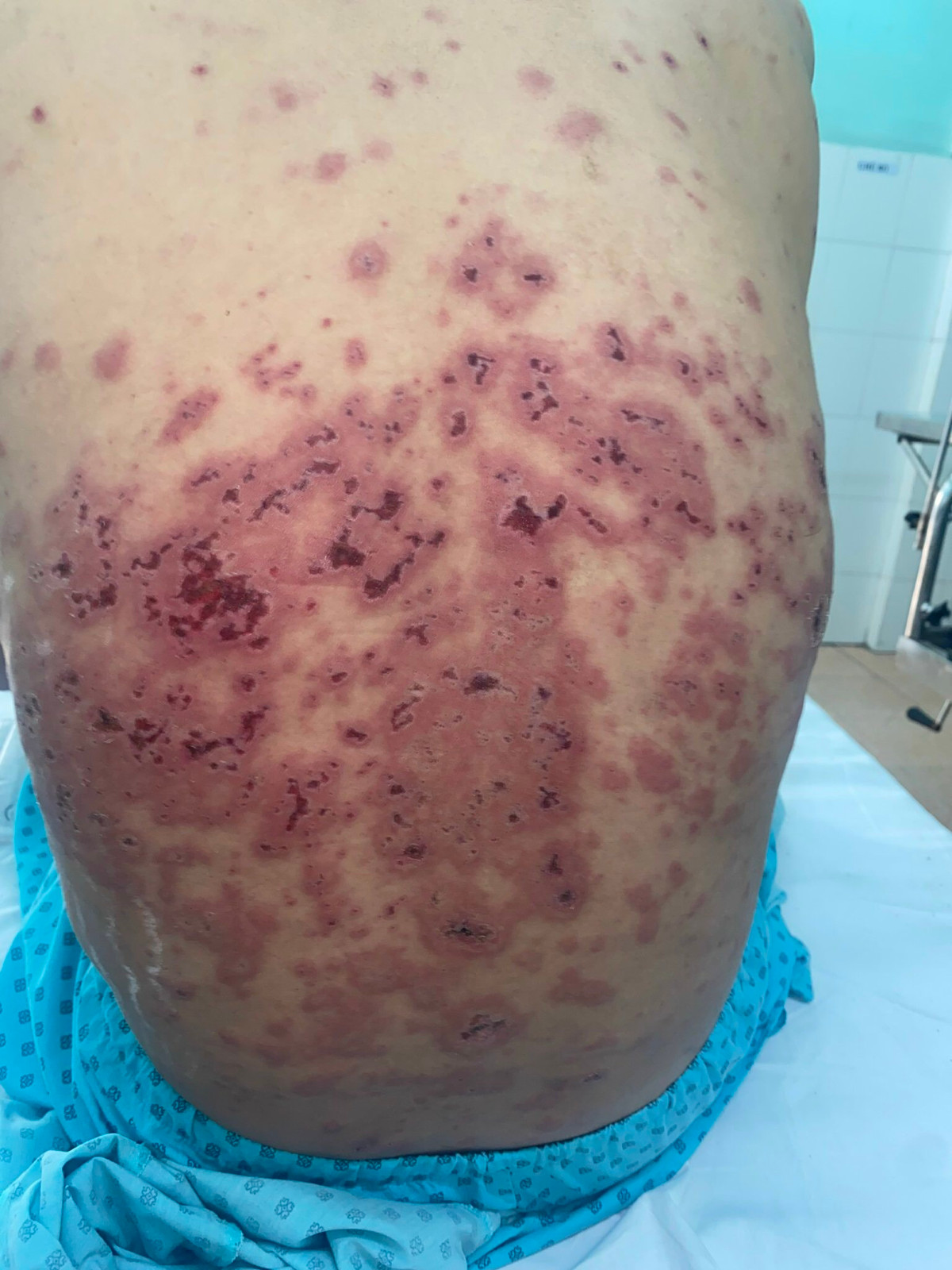 Lo loet toan than, rung toc vi benh Rowell hiem gap-Hinh-3