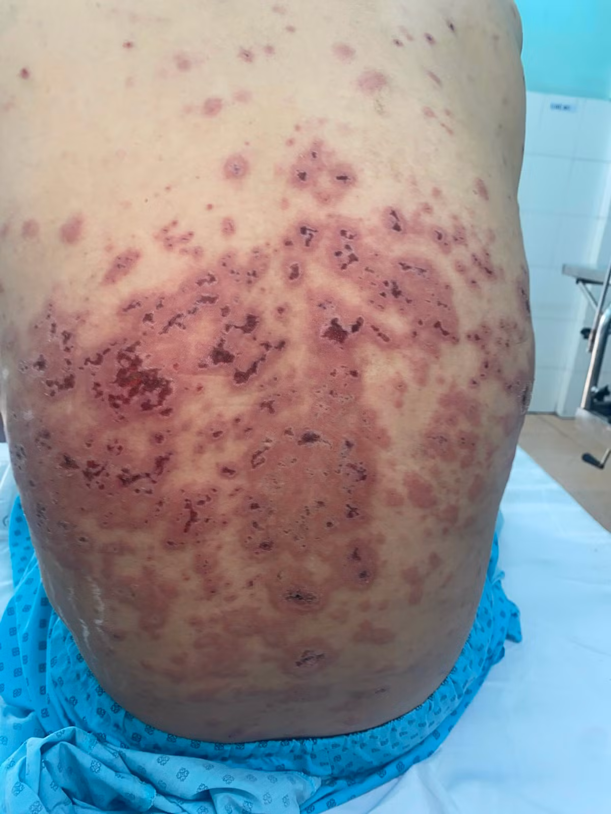 Lo loet toan than, rung toc vi benh Rowell hiem gap-Hinh-3