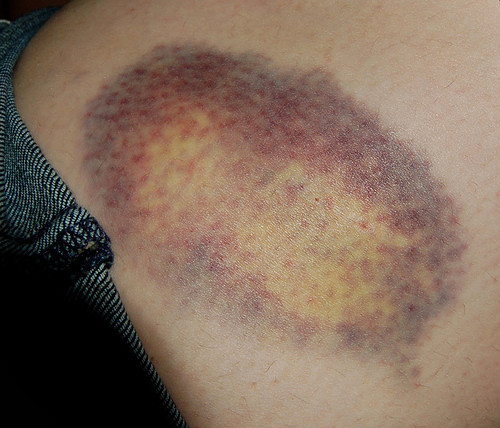 Chà một lát hành lên khu vực da bị thâm để giảm sưng cũng là cách làm mờ vết thâm.