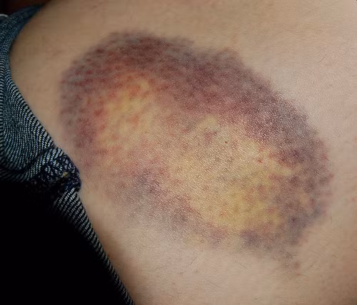 Chà một lát hành lên khu vực da bị thâm để giảm sưng cũng là cách làm mờ vết thâm.