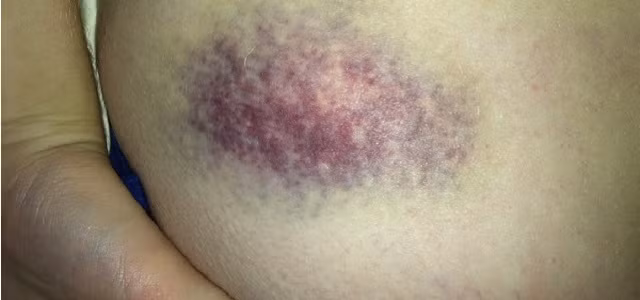 Dùng giấm pha với nước ấm rồi bôi lên vùng da bị thâm. Cách này giúp máu ở khu vực dưới vết thâm được lưu thông, làm vết thâm từ từ biến mất.