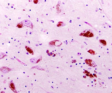 Bệnh mất trí thể dạng Lewy là một dạng khác của bệnh Parkinson. Ở bệnh này, người bệnh thường thấy cơ cứng ngắc, gặp khó khăn trong việc đưa ra quyết định, trí nhớ cũng gặp vấn đề và khả năng tập trung giảm dần.