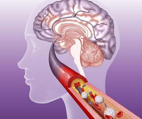 Sa sút trí tuệ mạch máu là một bệnh có liên quan tới chứng mất trí, với biểu hiện là khó tìm từ diễn đạt, mất trí nhớ, khó khăn trong vận động và nói năng.