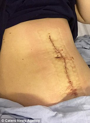 Và hiện tượng nhiễm trùng ở bụng cô cũng khỏi dần.