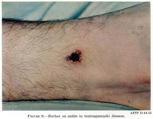 Bệnh truyền sang người qua côn trùng trung gian ấu trùng mò. Ảnh: Infonet.